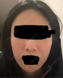 ジャルプロ ウィルビークリニック 新宿院 AFTER サムネイル用