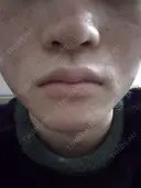 イオン導入 / ピーリング（ハリ・ツヤ） / ルメッカ ルラ美容クリニック 札幌本院 AFTER サムネイル用