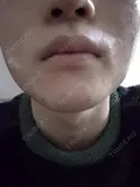 イオン導入 / ピーリング（ハリ・ツヤ） / ルメッカ ルラ美容クリニック 札幌本院 DAY 0 サムネイル用