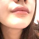 ヒアルロン酸注入（唇） / ボトックス（口角） ルラ美容クリニック 名古屋本院 DAY 2 サムネイル用