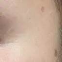 ほくろ・いぼ除去レーザー（肌） Fellez Clinic【フェルズクリニック】 DAY 32 サムネイル用