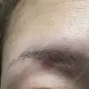 ほくろ・いぼ除去レーザー（肌） Fellez Clinic【フェルズクリニック】 DAY 32 サムネイル用