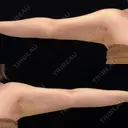 脂肪吸引（二の腕） EMMA CLINIC（エマクリニック） AFTER サムネイル用