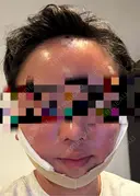 糸リフト / 脂肪吸引（顔） / 脂肪注入（額） / ボトックス（エラ・小顔） / ボトックス（口角） / 脂肪注入（輪郭） / その他（輪郭） 4Dクリニック DAY 1 サムネイル用