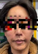 糸リフト / 脂肪吸引（顔） / 脂肪注入（額） / ボトックス（エラ・小顔） / ボトックス（口角） / 脂肪注入（輪郭） / その他（輪郭） 4Dクリニック AFTER サムネイル用