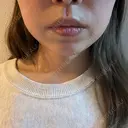 ボトックス（エラ・小顔） / インモード Moon Beauty Clinic DAY 0 サムネイル用