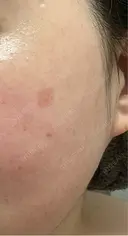 その他（肌） / シミ取りレーザー / ルメッカ ルラ美容クリニック 郡山院 DAY 28 サムネイル用