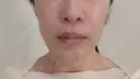 糸リフト / バッカルファット除去 / 脂肪吸引（顔） / ジョールファット除去 / ボトックス（エラ・小顔） アリエル美容クリニック 大宮院 DAY 62 サムネイル用