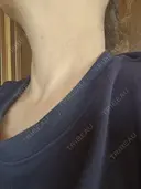 ハイフ（首） アクティブエイジクリニック DAY 2 サムネイル用