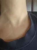 ハイフ（首） アクティブエイジクリニック AFTER サムネイル用