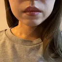 ボトックス（エラ・小顔） / インモード Moon Beauty Clinic DAY 1 サムネイル用