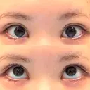 タレ目形成・グラマラスライン（切開） 形成外科と美容外科のクリニック池袋 DAY 26 サムネイル用