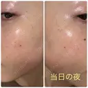 ピーリング（ニキビ・毛穴） / イオン導入 / ルメッカ ルラ美容クリニック 札幌本院 DAY 0 サムネイル用