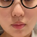 ピコレーザートーニング（美白・肝斑） 東京美容皮膚科アロエクリニック池袋 DAY 3 サムネイル用