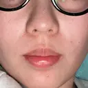 ピコレーザートーニング（美白・肝斑） 東京美容皮膚科アロエクリニック池袋 DAY 4 サムネイル用