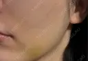 脂肪吸引注射（顔） APスキンクリニック銀座 DAY 8 サムネイル用
