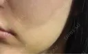 脂肪吸引注射（顔） APスキンクリニック銀座 DAY 10 サムネイル用