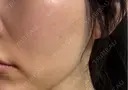 脂肪吸引注射（顔） APスキンクリニック銀座 DAY 11 サムネイル用