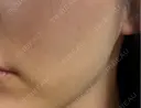 脂肪吸引注射（顔） APスキンクリニック銀座 DAY 13 サムネイル用