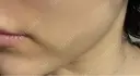 脂肪吸引注射（顔） APスキンクリニック銀座 DAY 15 サムネイル用