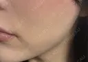 脂肪吸引注射（顔） APスキンクリニック銀座 DAY 16 サムネイル用