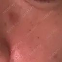 ほくろ・いぼ除去レーザー（肌） 心斎橋KT美容クリニック DAY 1 サムネイル用