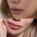 ヒアルロン酸注入（唇） HAAB BEAUTY CLINIC 名古屋院 DAY 1 サムネイル用