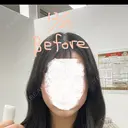 ボトックス（エラ・小顔） 東京美容皮膚科アロエクリニック池袋 DAY 0 サムネイル用