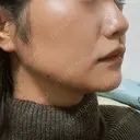 ボトックス（エラ・小顔） 新未来クリニック DAY 17 サムネイル用