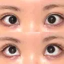 タレ目形成・グラマラスライン（切開） 形成外科と美容外科のクリニック池袋 DAY 27 サムネイル用