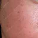 水光注射（ハリ・美肌） / 毛穴洗浄（ハイドラフェイシャルなど） RIN BEAUTY CLINIC DAY 2 サムネイル用