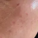 水光注射（ハリ・美肌） / 毛穴洗浄（ハイドラフェイシャルなど） RIN BEAUTY CLINIC DAY 2 サムネイル用