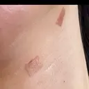 ほくろ・いぼ除去レーザー（肌） 心斎橋KT美容クリニック DAY 2 サムネイル用