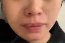 ピーリング（ニキビ・毛穴） Clara CLINIC 美容皮膚科・歯科 DAY 0 サムネイル用