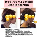 あごプロテーゼ / その他（輪郭） / セットバック / その他（審美歯科/矯正歯科） 大塚美容形成外科・歯科 大塚本院 DAY 126 サムネイル用