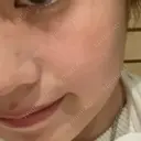 ピコレーザートーニング（美白・肝斑） 東京美容皮膚科アロエクリニック池袋 DAY 6 サムネイル用