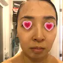 水光注射（ハリ・美肌） / ハイフ（顔） シロアム韓方美容・ダイエットクリニック(美&EYE) AFTER サムネイル用