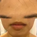 水光注射（ハリ・美肌） / ハイフ（顔） シロアム韓方美容・ダイエットクリニック(美&EYE) DAY 29 サムネイル用