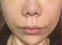 脂肪溶解注射（顔） ルラ美容クリニック 岡山院 DAY 5 サムネイル用