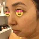 水光注射（ハリ・美肌） / ハイフ（顔） シロアム韓方美容・ダイエットクリニック(美&EYE) DAY 29 サムネイル用