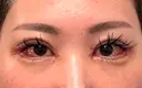 二重埋没 / 目頭切開 / 目尻切開 / タレ目形成・グラマラスライン（切開） / 目尻靭帯移動 BITO BEAUTY CLINIC DAY 6 サムネイル用