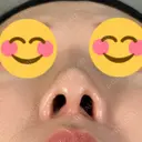 鼻尖形成（切開） / 人中短縮 / 鼻孔縁挙上 / その他（鼻） アリエル美容クリニック 大宮院 DAY 441 サムネイル用