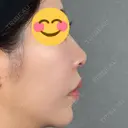 鼻尖形成（切開） / 人中短縮 / 鼻孔縁挙上 / その他（鼻） アリエル美容クリニック 大宮院 DAY 441 サムネイル用