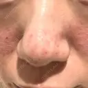 キュアジェット レナータクリニック 立川院 DAY 0 サムネイル用