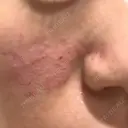 キュアジェット レナータクリニック 立川院 DAY 0 サムネイル用