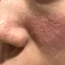 キュアジェット レナータクリニック 立川院 DAY 0 サムネイル用