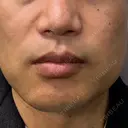 ボトックス（エラ・小顔） BiBiクリニック DAY 0 サムネイル用