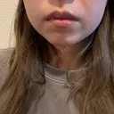 ボトックス（エラ・小顔） / インモード Moon Beauty Clinic DAY 4 サムネイル用