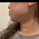 ボトックス（エラ・小顔） / インモード Moon Beauty Clinic DAY 4 サムネイル用