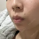 ボトックス（あご） / 肌ヒアルロン酸注入（たるみ・シワ改善） BIZENNクリニック【ビゼンクリニック】 DAY 8 サムネイル用